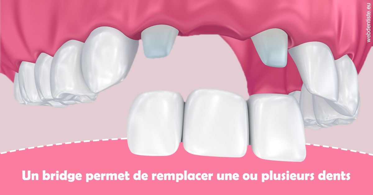 https://dr-durant-valery.chirurgiens-dentistes.fr/Bridge remplacer dents 2