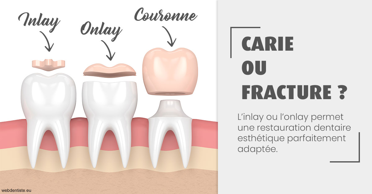 https://dr-durant-valery.chirurgiens-dentistes.fr/T2 2023 - Carie ou fracture 1
