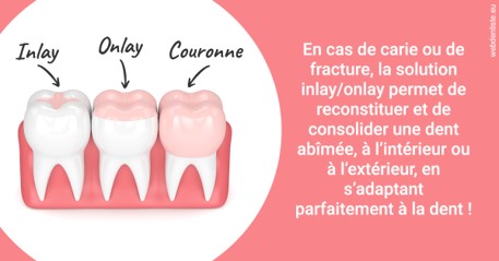 https://dr-durant-valery.chirurgiens-dentistes.fr/L'INLAY ou l'ONLAY 2