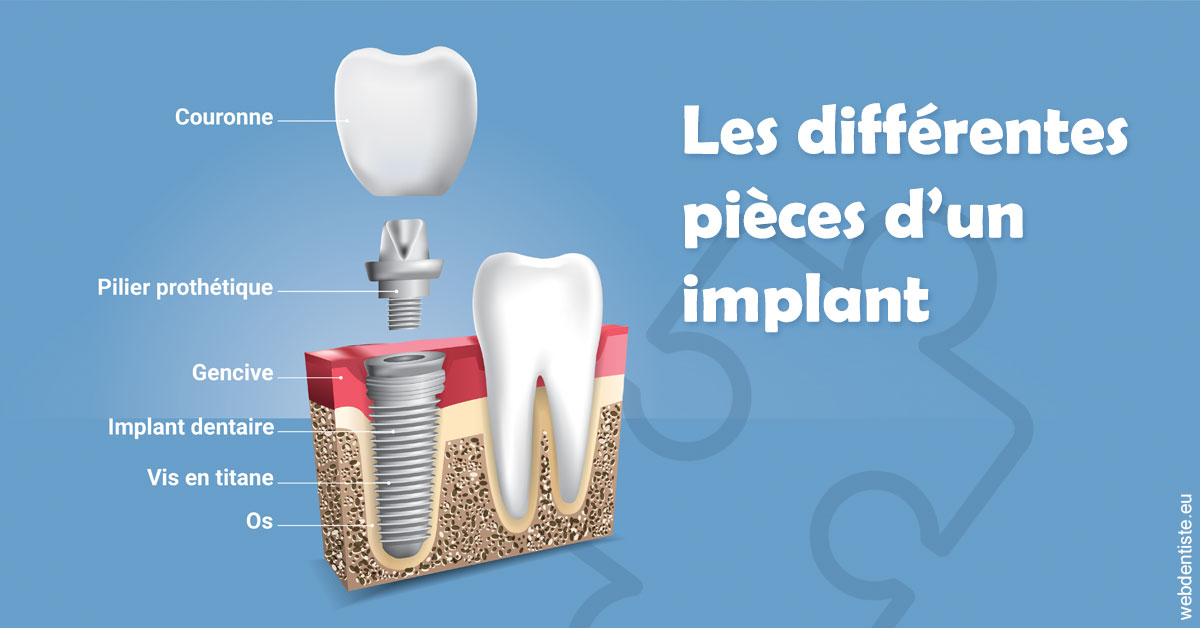 https://dr-durant-valery.chirurgiens-dentistes.fr/Les différentes pièces d’un implant 1